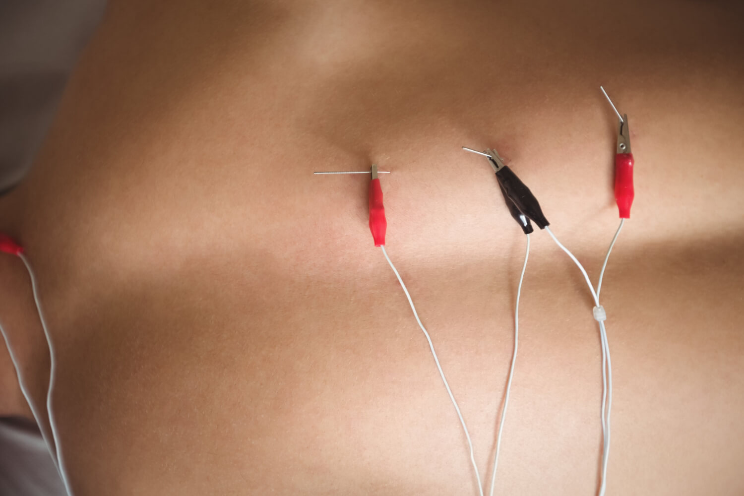 Fisioterapeuta en FisioSpace Génova, tu clínica de fisioterapia en Madrid, aplicando neuromodulación percutánea para aliviar el dolor crónico y mejorar la función nerviosa en pacientes con afecciones musculoesqueléticas y neurológicas