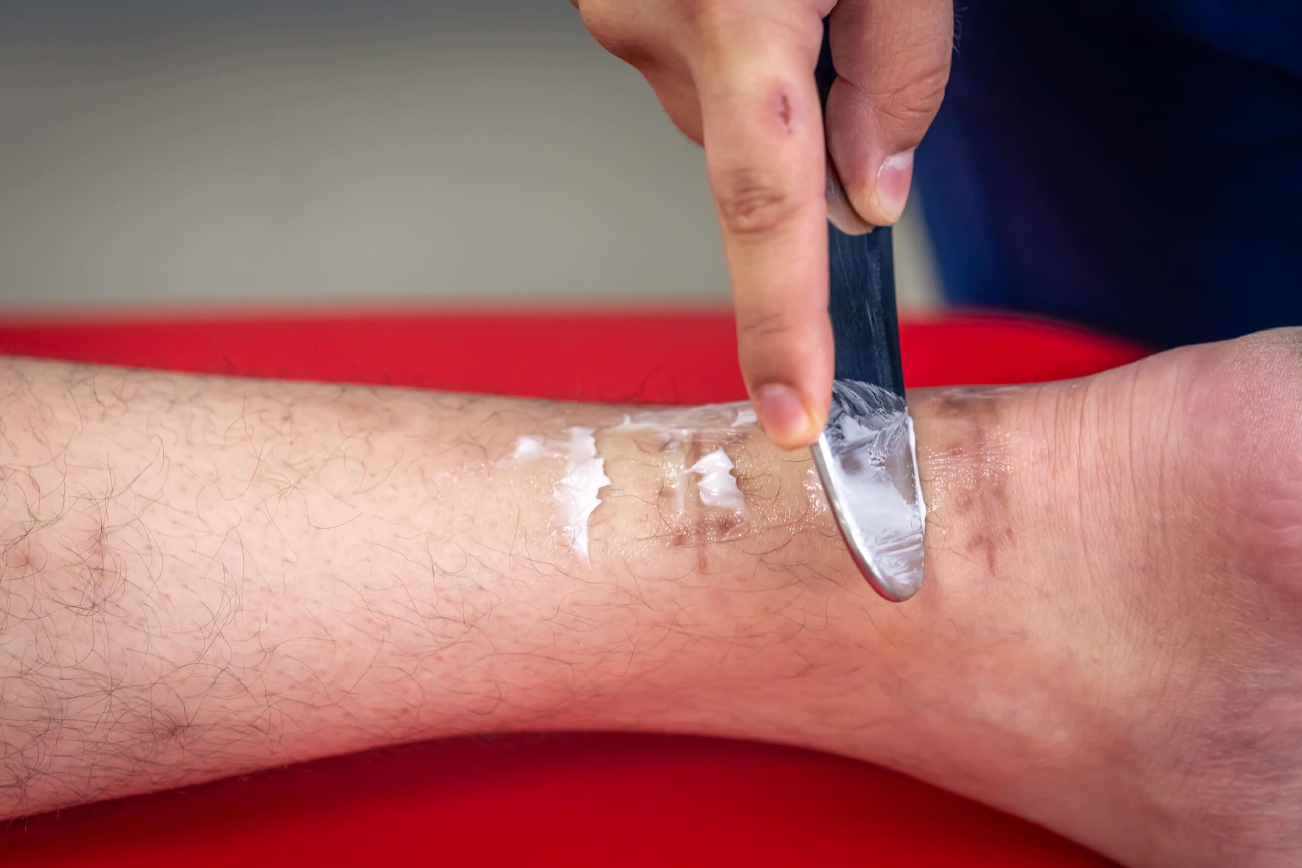 Fisioterapeuta aplicando crema y utilizando un instrumento sobre una cicatriz para tratar adherencias y fibrosis postquirúrgicas.