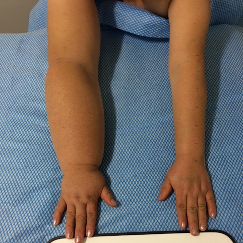 Brazos de una paciente con linfedema tras cáncer de mama apoyados en la camilla
