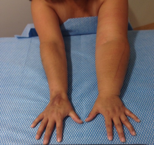 Brazos de una paciente con linfedema tras cáncer de mama