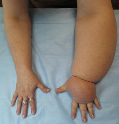 Fisioterapeuta realizando drenaje linfático manual en brazo derecho de paciente con linfedema postoperatorio por cáncer de mama