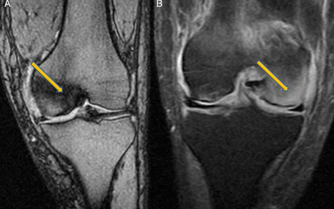 Edema óseo de rodilla: tratamiento eficaz en Madrid con Magnetolith®