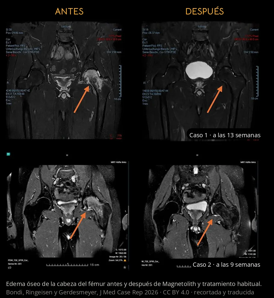 Resonancias de dos pacientes con edema óseo de la cabeza del fémur antes y después del tratamiento con Magnetolith