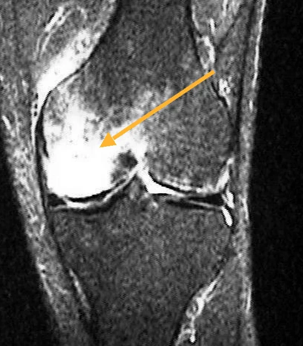 Resonancia magnética de rodilla con una gran mancha blanca en el cóndilo femoral medial señalada con una flecha: es un edema óseo