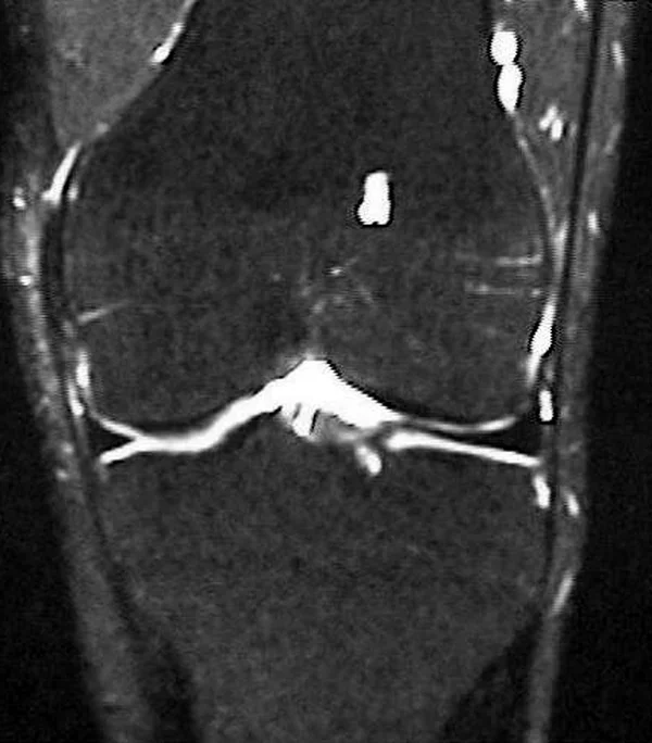Resonancia magnética de la misma rodilla seis meses después, con el hueso oscuro y uniforme, ya sin edema óseo